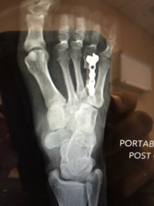 Portable x-rays showing the DP view of the metatarsal lengthening in brachymetatarsia. 